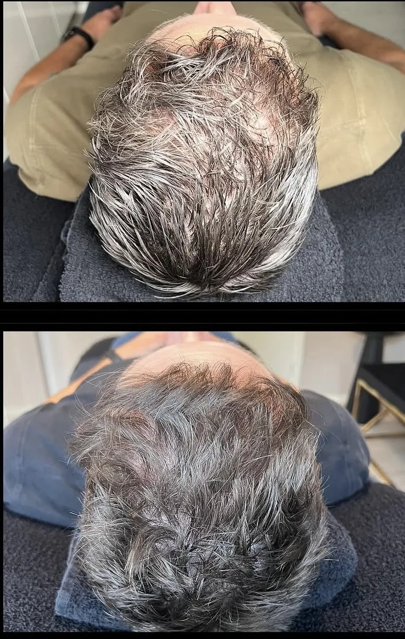 Voor en na Stamcel Hair Therapy, bovenaanzicht