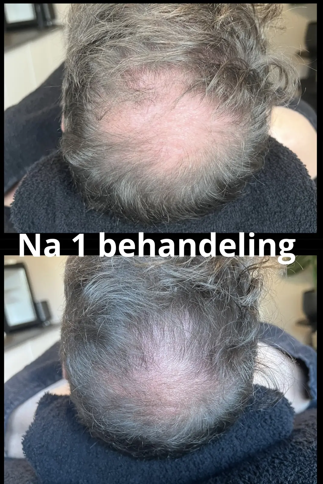 Resultaat van Stamcel Hair Therapy na één behandeling