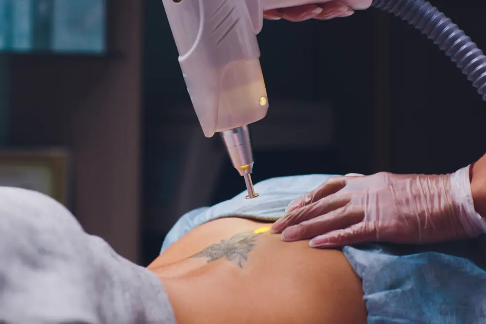 Tatoeage verwijderen met een picolaser